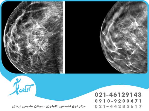ماموگرافی سرطان سینه 
