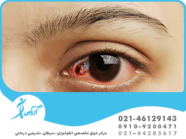 روش های درمان سرطان چشم 