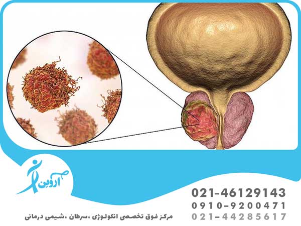 سرطان پروستات مردان در ایران