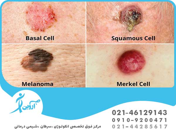 انواع سرطان پوست