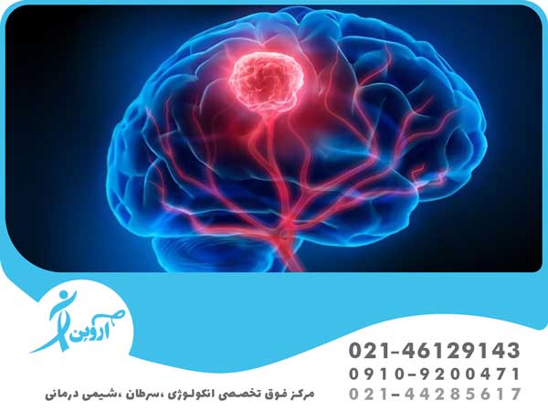روش های درمان سرطان مغز 