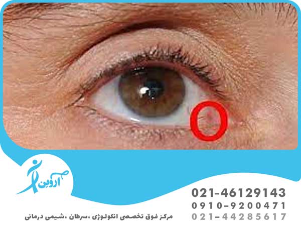 درمان سرطان چشم با جراحی