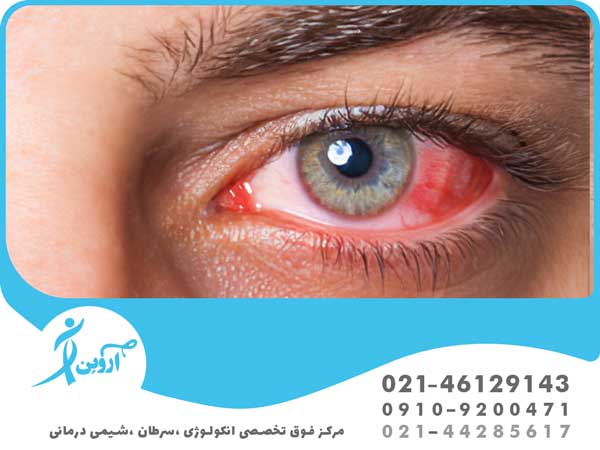 درمان سرطان چشم با پرتودرمانی