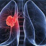 سرطان ریه چیست و چگونه درمان می شود