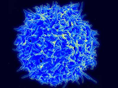 لوسمی سلول T بالغین